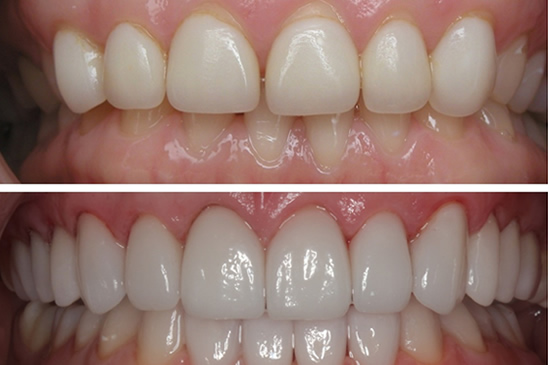 Carillas Dentales en Porcelana